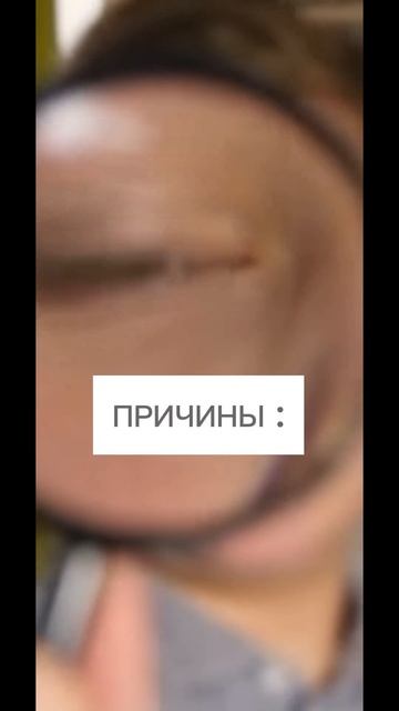 Заеду в уголках рта. В чем причина? #shorts #заеды #высыпан?