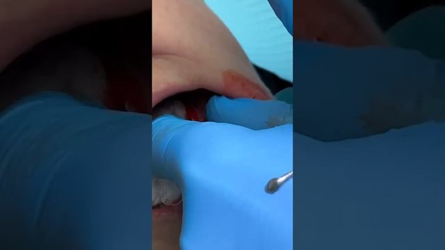 Корень 3.5 зуба. Удаление разрушенного зуба снизу слева смотреть онлайн