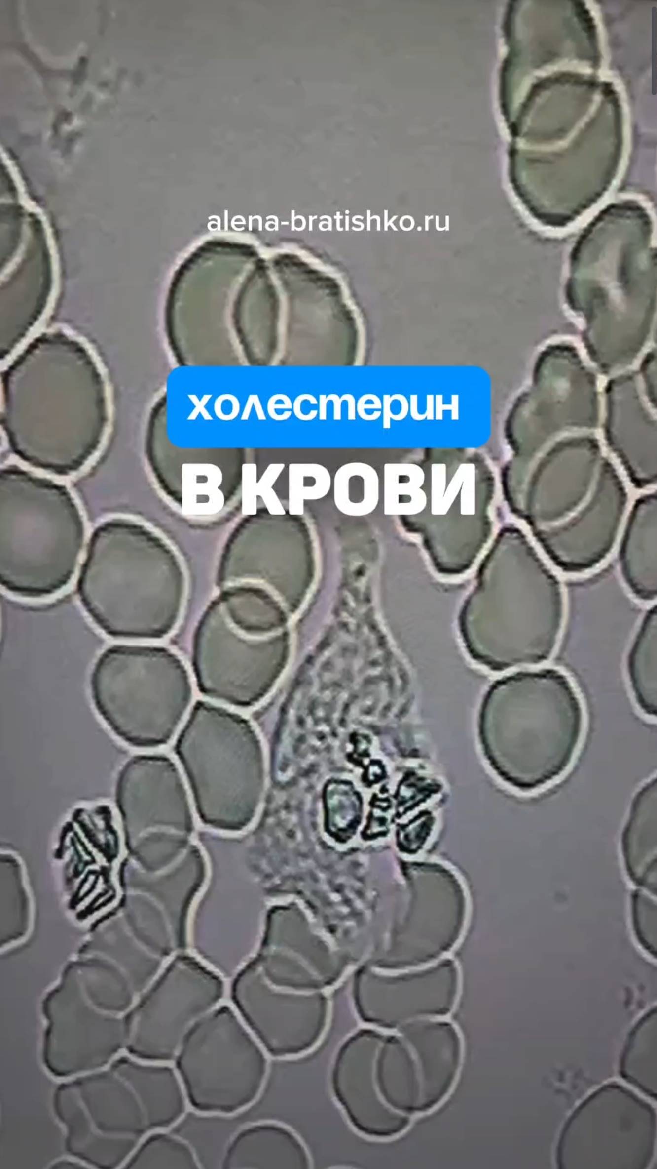 Холестерин в крови. Алена Братишко смотреть онлайн