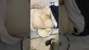 Уход за цистостомой: самостоятельная обработка в дома