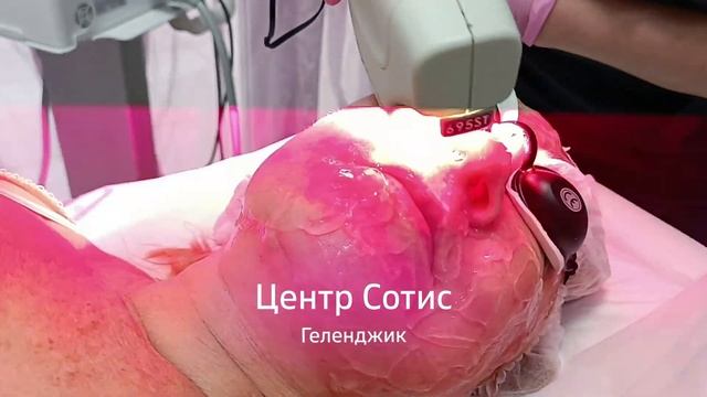 Фотоомоложение Sciton BBL в Сотис Геленджик