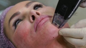 Morpheus 8: современный подход к профилактике старения