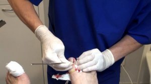 Операция на вросших ногтях в клинике хирургии доктора