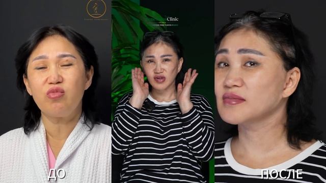 FACE LIFTING - YEAR ПОДТЯЖКА ЛИЦА - ЛЕТ-YUZ TORTTIRISH YOSH