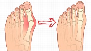 Как избавиться от косточки на большом пальце ноги без операций!