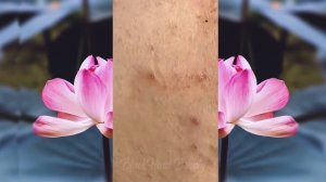 Новое выдавливание ПРЫЩЕЙ и ЧЕРНЫХ ТОЧЕК!  p8