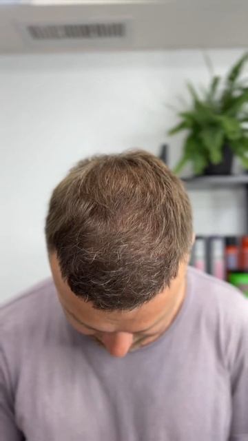 7 месяцев после пересадки волос в Стамбуле 🇹🇷