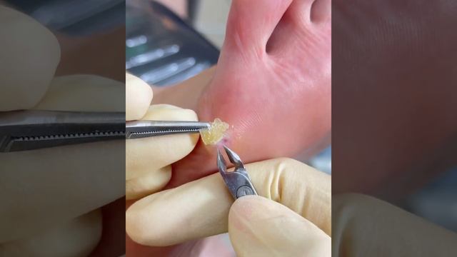 Удаление стержневой мозоли смотреть онлайн