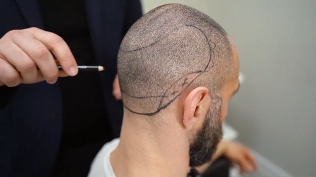 ИДЕАЛЬНАЯ ДОНОРСКАЯ ЗОНА, КАКАЯ ОНА? смотреть онлайн