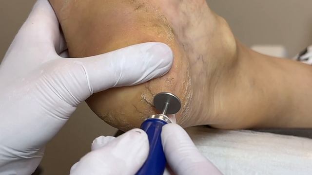 Сложный педикюр. Работа с элементами Подологии. Обраб? смотреть онлайн