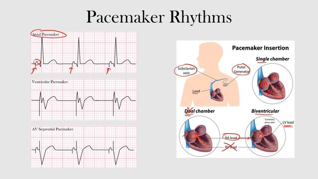 66.Pacemaker Rhythms смотреть онлайн