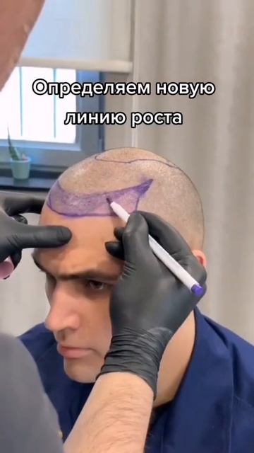 Пересадка волос в Турции #пересадкаволос смотреть онлайн