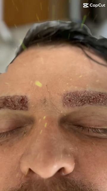пересадка брове #пересадка #дизайн Eyebrow Transplant