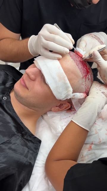 Не больно! Пересадка волос в спб #пересадкаволос #втоп?