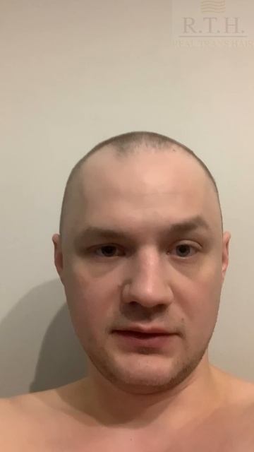 До и после пересадки смотреть онлайн