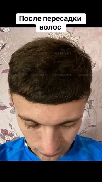 До и после пересадки волос #пересадкаволос #пересадка? смотреть онлайн