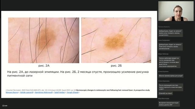 Вебинар: спорные вопросы лазерной эпиляции боль клие