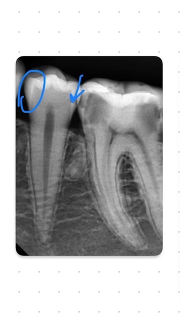 Рубрика: рентген диагностика. Разбираем прицельный сн смотреть онлайн
