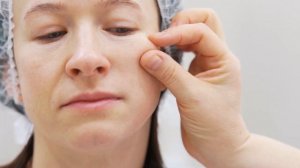 Смас-лифтинг Альтера. Отвечаем на часто задаваемые во?