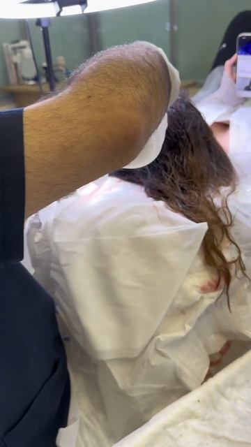 пересадка волос для женщин DHI методы