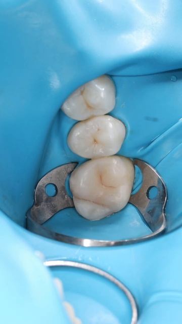 Кариес до после. Лечение зубов под микроскопом. Фотопр смотреть онлайн