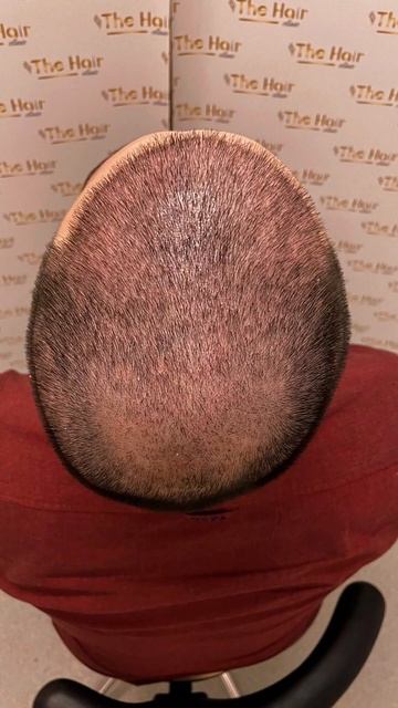 Пересадка волос. Результат спустя 10 дней. #пересадкаво