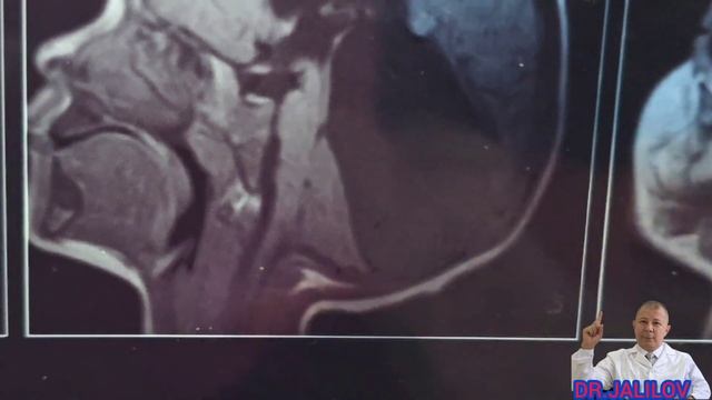 ГИДРОЦЕФАЛИЯ ВАРИАНТ ДЕНДИ УОКЕРА ЛИЧНЫЯ //Dr.JALILOV