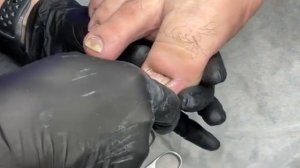 Работа с вросшим ногтем подолога Ольги Чистиковой