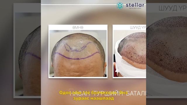 💬Үс суулгах мэс ажилбарт орсон сэтгэгдлээ хуваалцса? смотреть онлайн