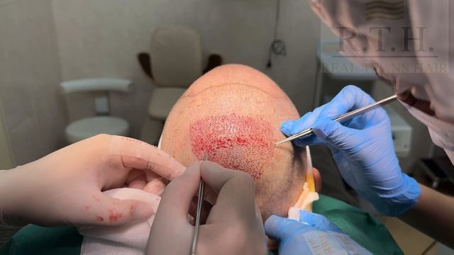 Последний этап в пересадке волос- вживление графтов❗️ смотреть онлайн