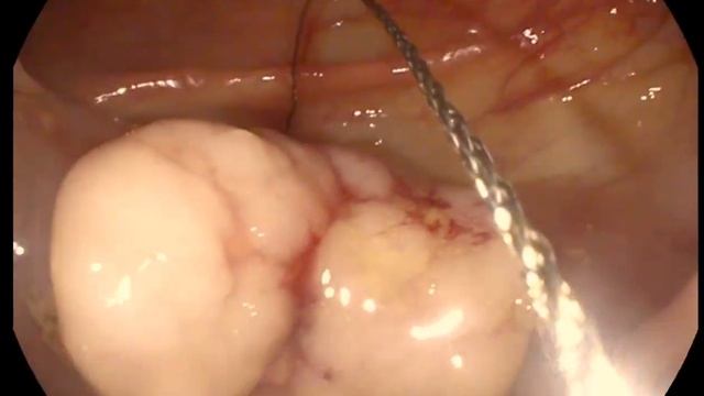 Удаление доброкачественного эпителиального  образов?