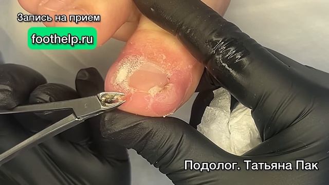 Махровая форма вросшего ногтя. 12 лет