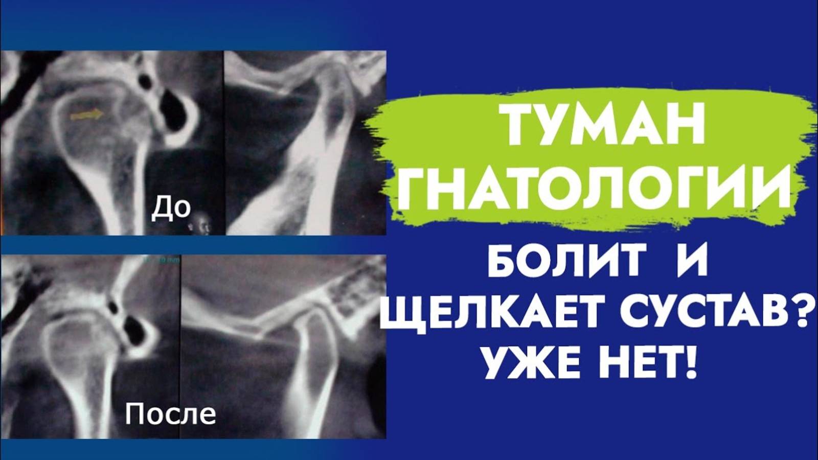 ВНЧС. Лечение дисфункции и артроза височно-нижнечелюстного сустава!