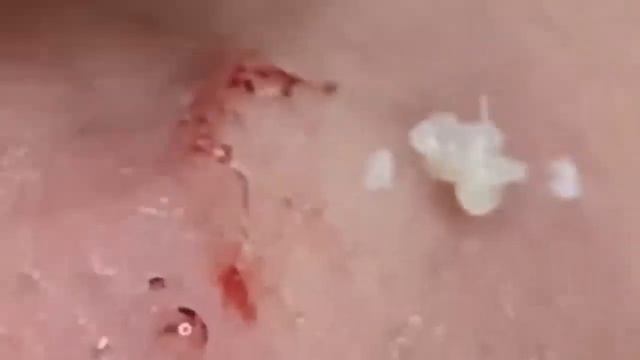 Выдавливание прыщей. Угри. Акне. чистка лица кожи