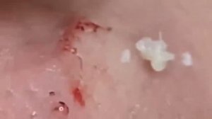 Выдавливание прыщей. Угри. Акне. чистка лица кожи