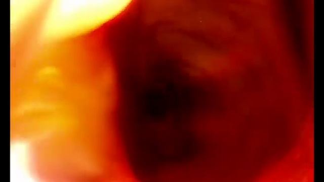 Опухоль прямой кишки у собаки, колоноскопия смотреть онлайн