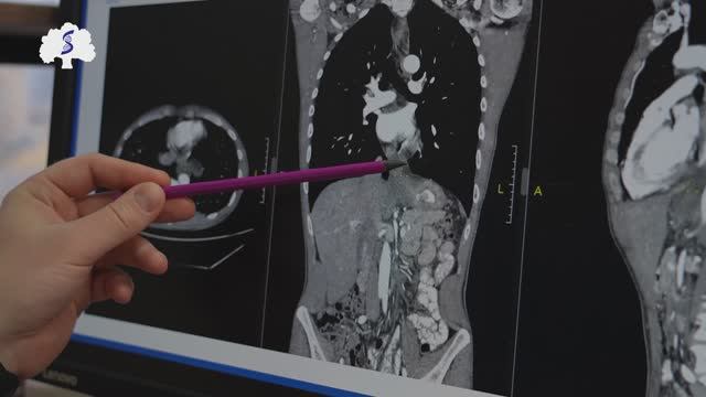 Хирурги Сеченовского Университета удалили пациенту опухоль рядом с сердцем смотреть онлайн