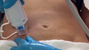 Микроигольчатый RF лифтинг