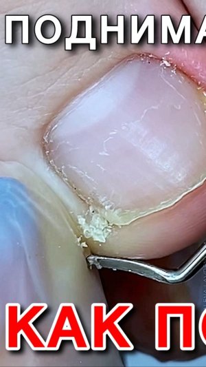 РОДИТЕЛЯМ СПОРТСМЕНОВ - следите за их ногтями