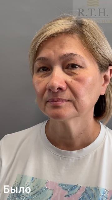 Неделя после верхней и нижней блефаропластики! смотреть онлайн