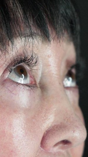 Проект "Оморфия" омоложение лица и шеи - результат
Хирург: Свиридов Максим Константинович