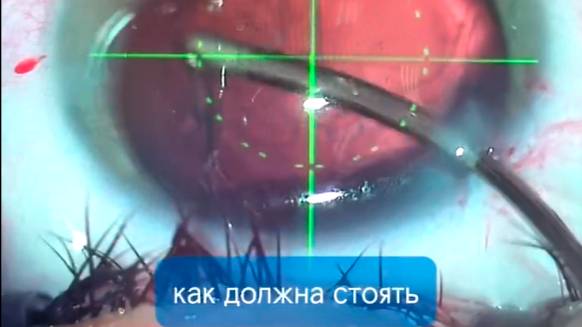 Мультифокальный торический хрусталик при астигматизме 3 диоптрии | Современное решение в 35 лет 👁️ смотреть онлайн