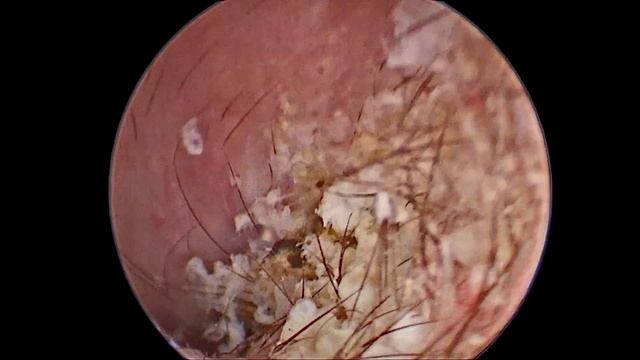 450446 Отоскопия лазерная абляция новообразований НСП
