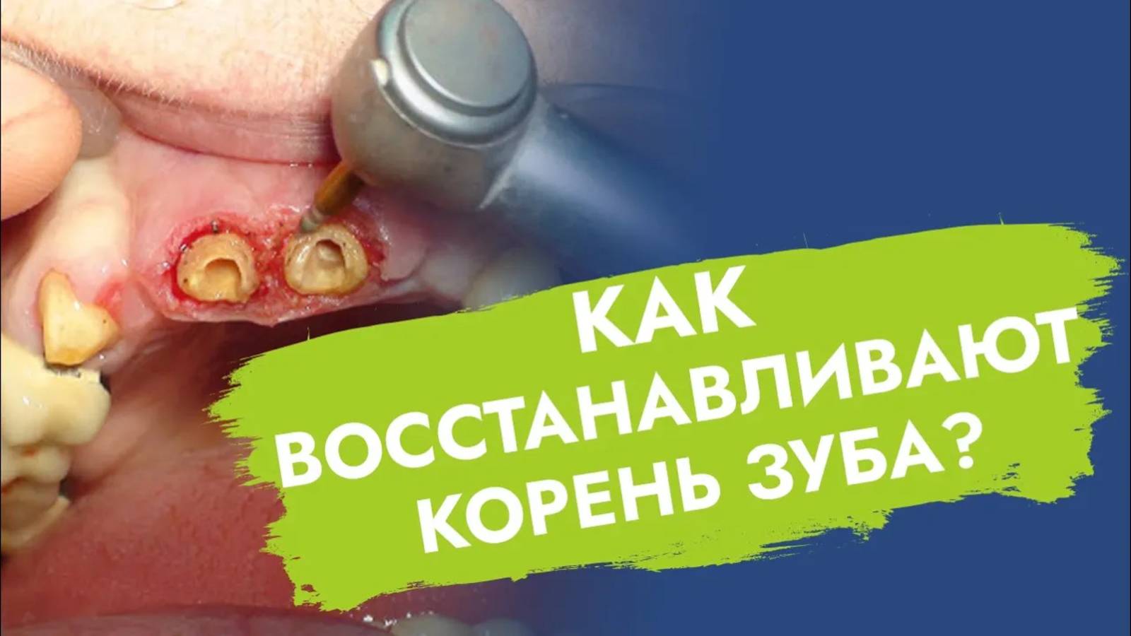 Что делать с зубом, если остался только корень?
