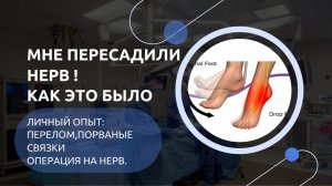 Жизнь с висящей стопой и разорванными связками | Уникальная операция по пересадке нерва