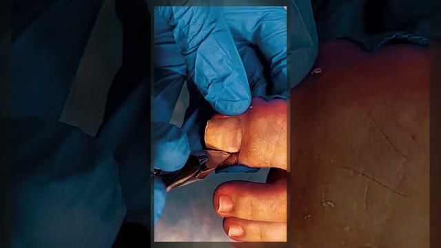 Удаление вросшего ногтя,гранулёма,тяжёлый случай.Леч? смотреть онлайн