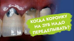 Если коронку на зуб менять своевременно - зуб простоит всю жизнь!