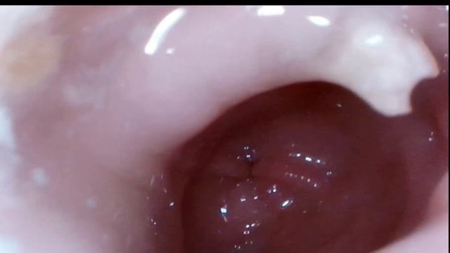 Жуткий эзофагит у кошки после операции по поводу хиат? смотреть онлайн