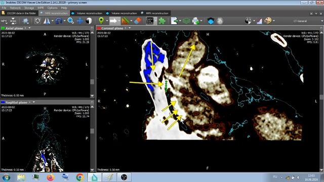ШУНТЫ КЛАПАНЫ СЕРДЦЕ АРТЕРИИ ВЕНЫ . смотреть онлайн