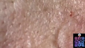 ЧЕРНЫЕ ТОЧКИ И ПРЫЩИ УДАЛЕНИЕ / ВЫДАВЛИВАНИЕ ПРЫЩЕЙ